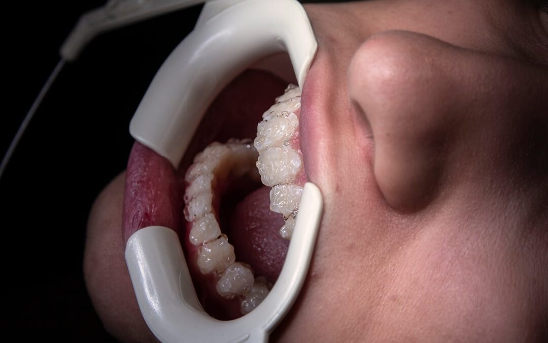 Photo Oral cancer epidemiology
