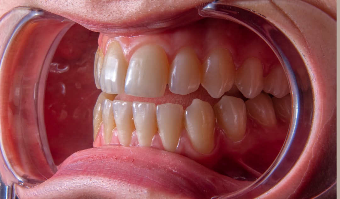 Photo Oral thrush