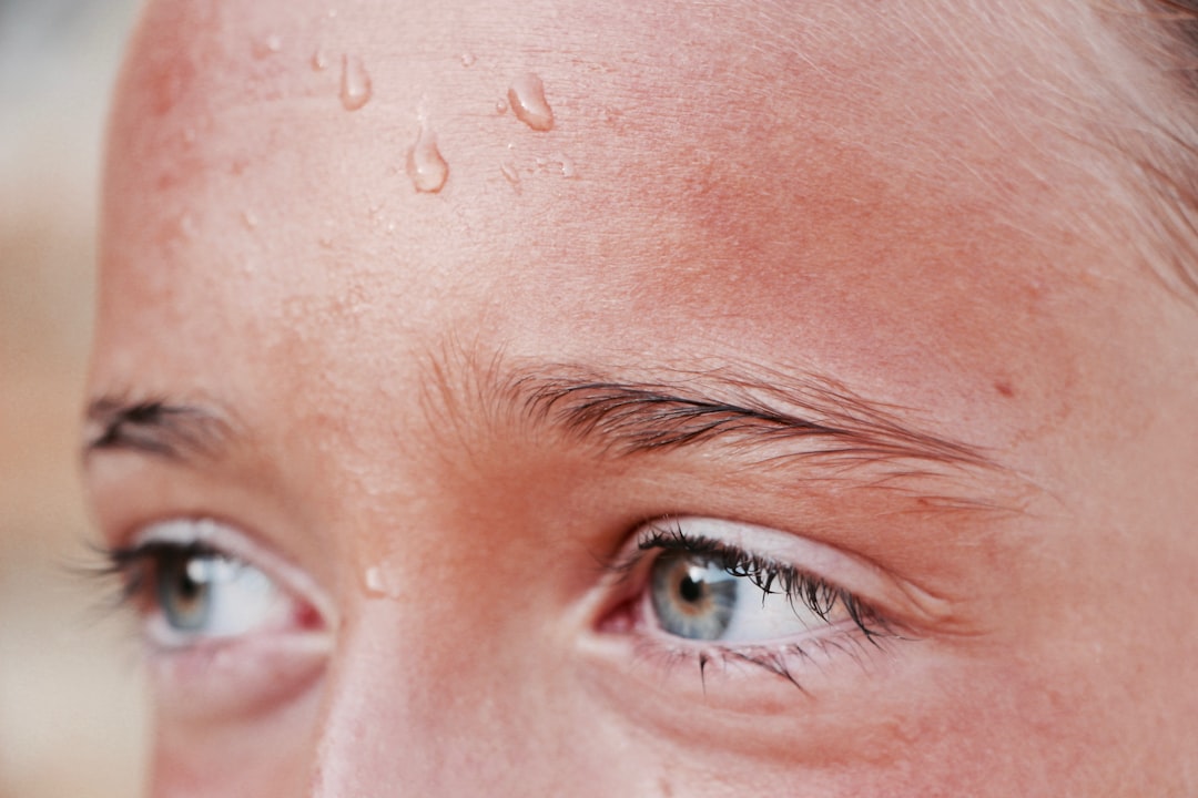 Photo Acne breakout