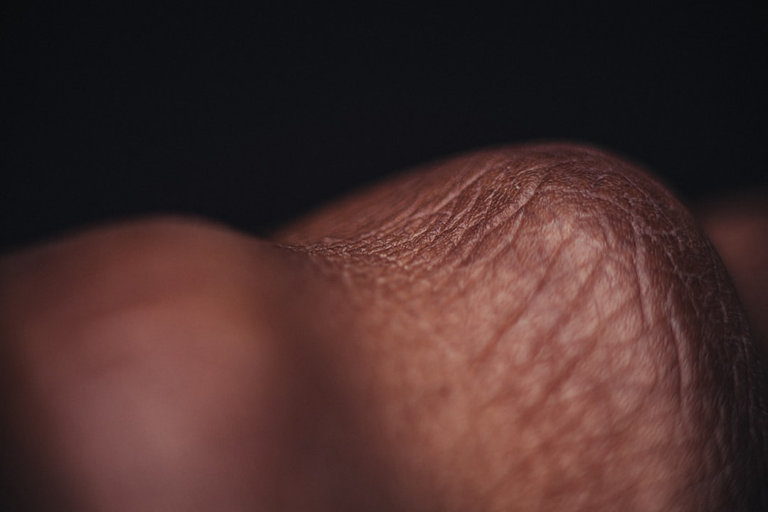 Photo Wart on finger