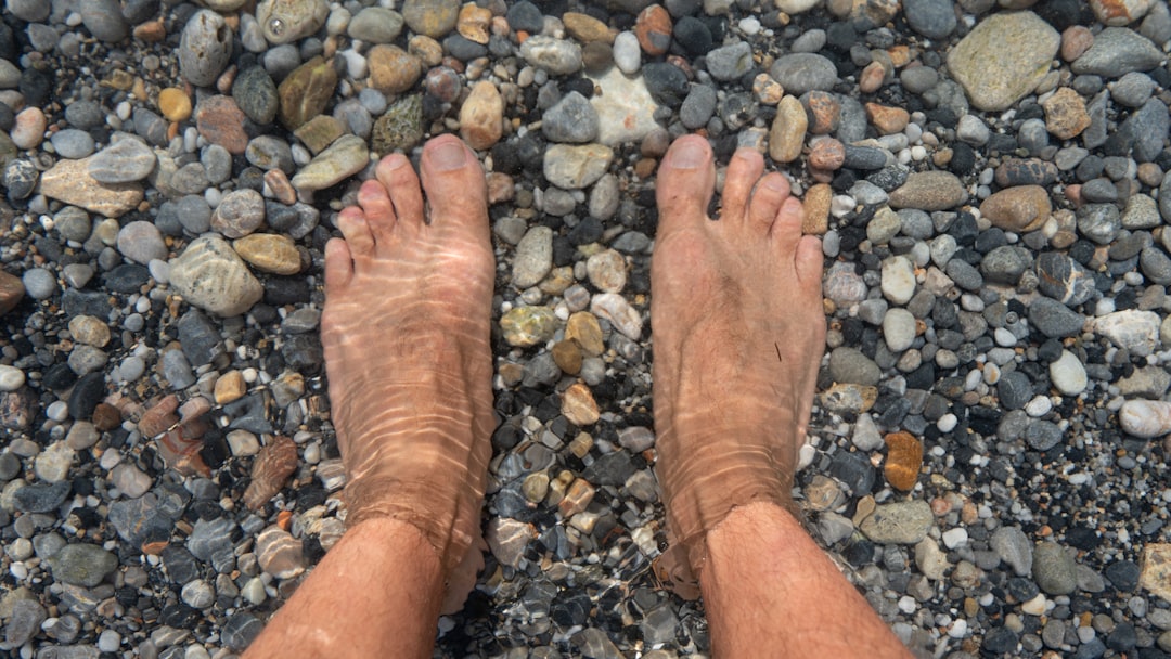 Photo Foot with wart