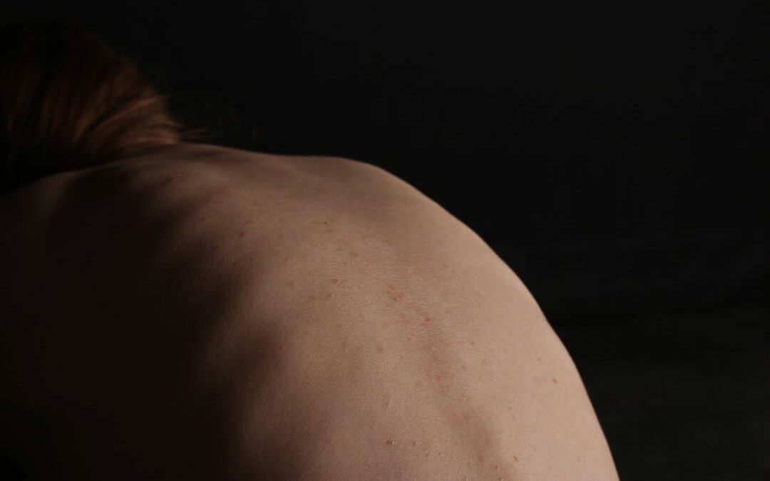 Photo Skin tag