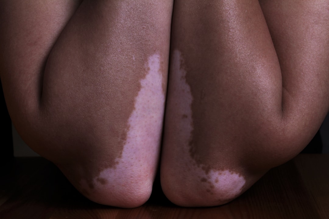 Photo blister treatment