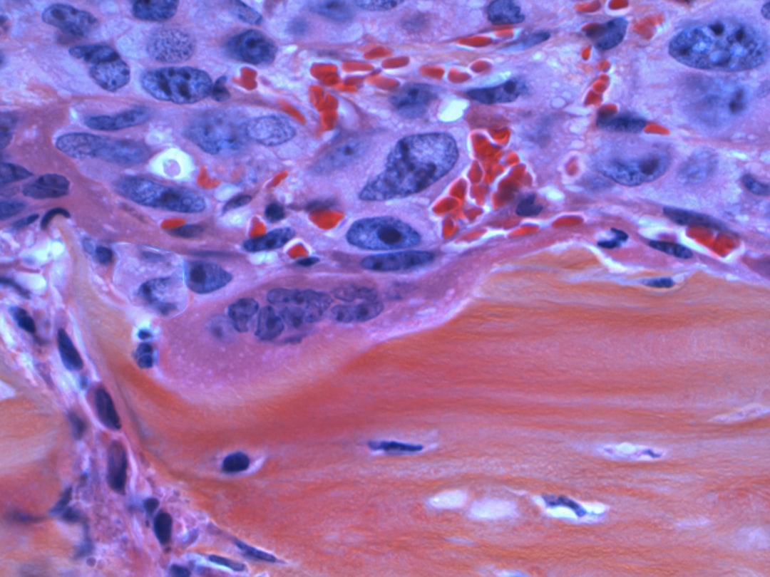 Photo colorectal cancer