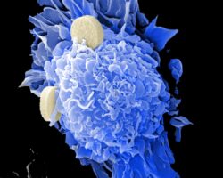Photo colorectal cancer metastasis