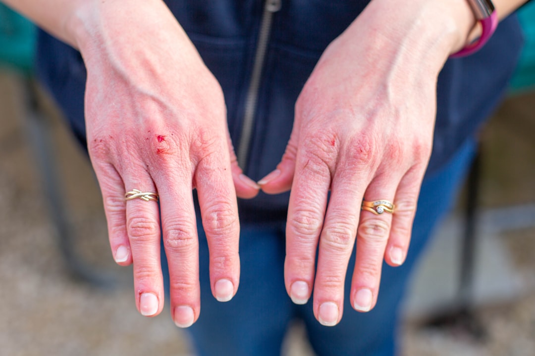 Photo herpes rash removal
