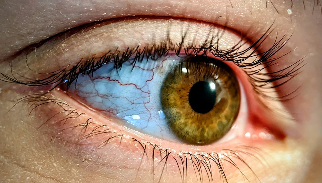 Photo glaucoma