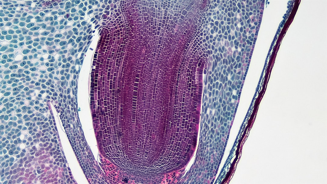 Photo planar xanthoma