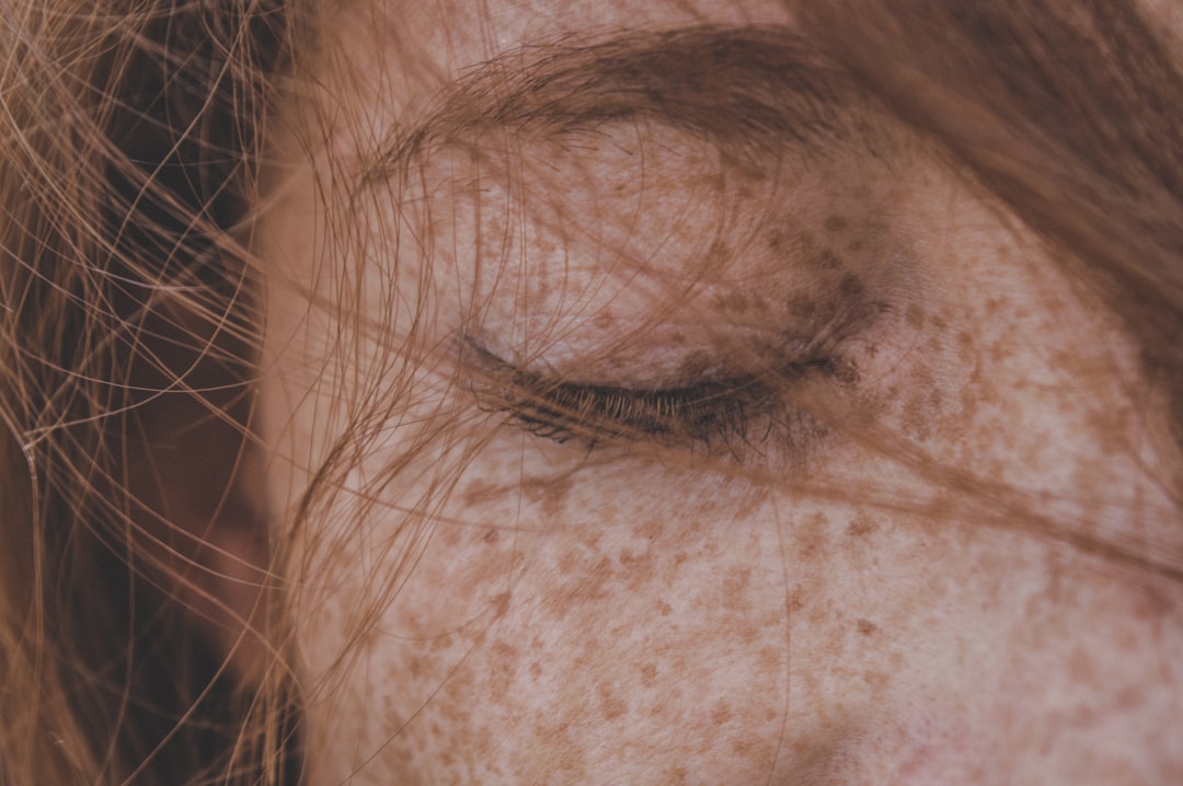 Photo skin symptoms