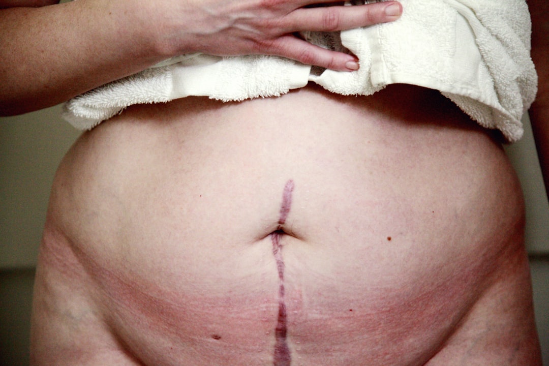 Photo 20-week fetal reduction