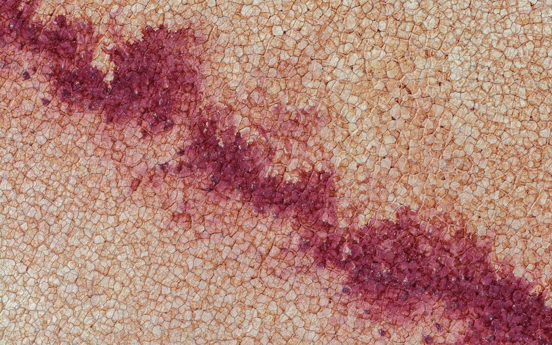 Photo homoktövis allergy
