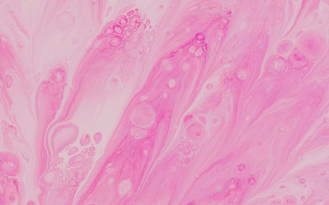 Photo endometriosis