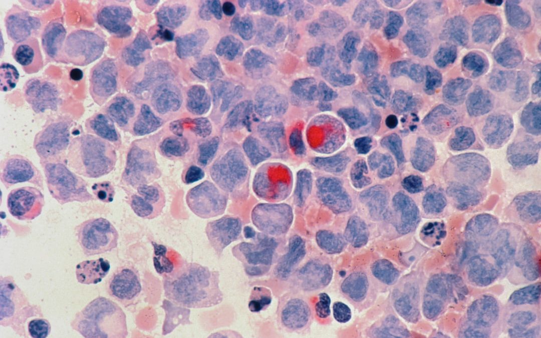 Photo lymphoma