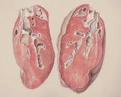 Photo colon diseases