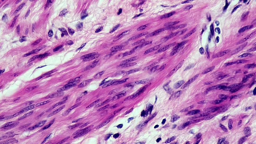 Photo malignant lymphoma