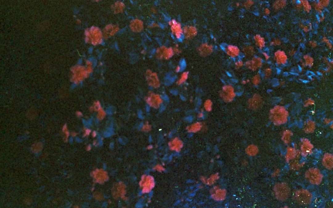 Photo lymphoma