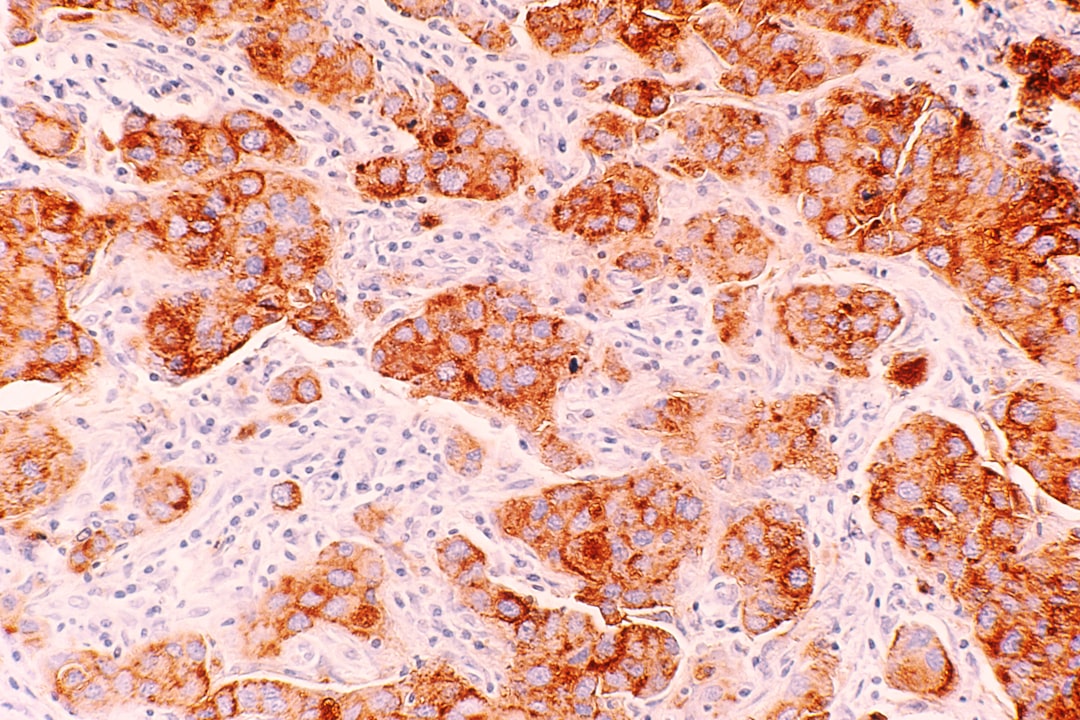Photo diffuse large B-cell lymphoma