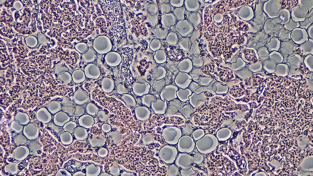 Photo lymphoma