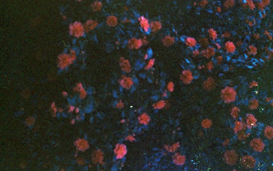 A limfóma tünetei és kezelése mellkasban