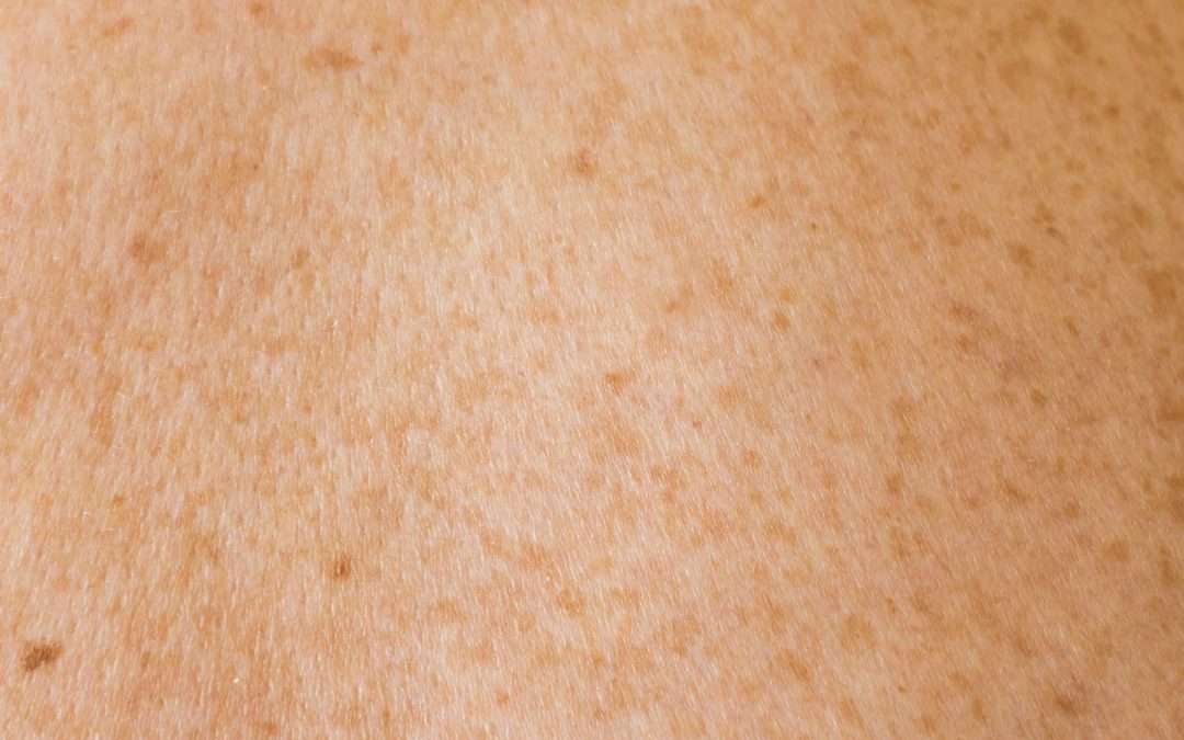 Photo skin diseases pictures