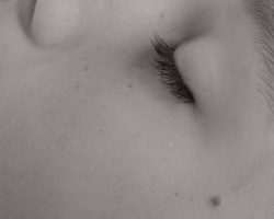 Photo dry skin disease